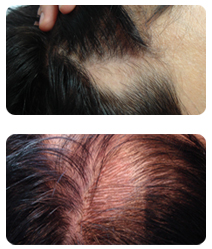 Permanent cosmetics for bald spot.