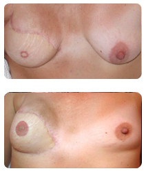 Permanent cosmetics for areola reconstruction.